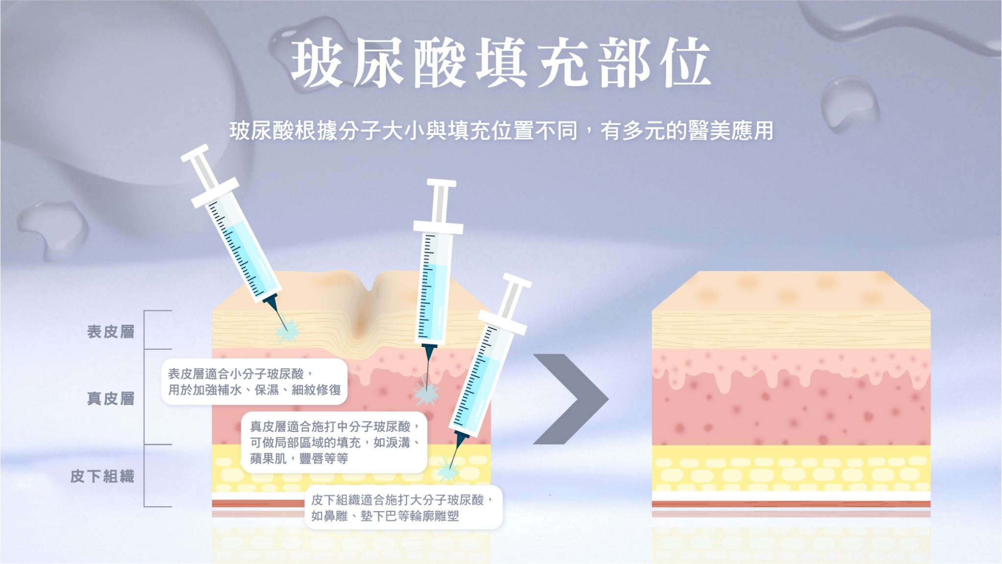 晶鑽診所 玻尿酸 緹奧希Teosyal 臉部填充