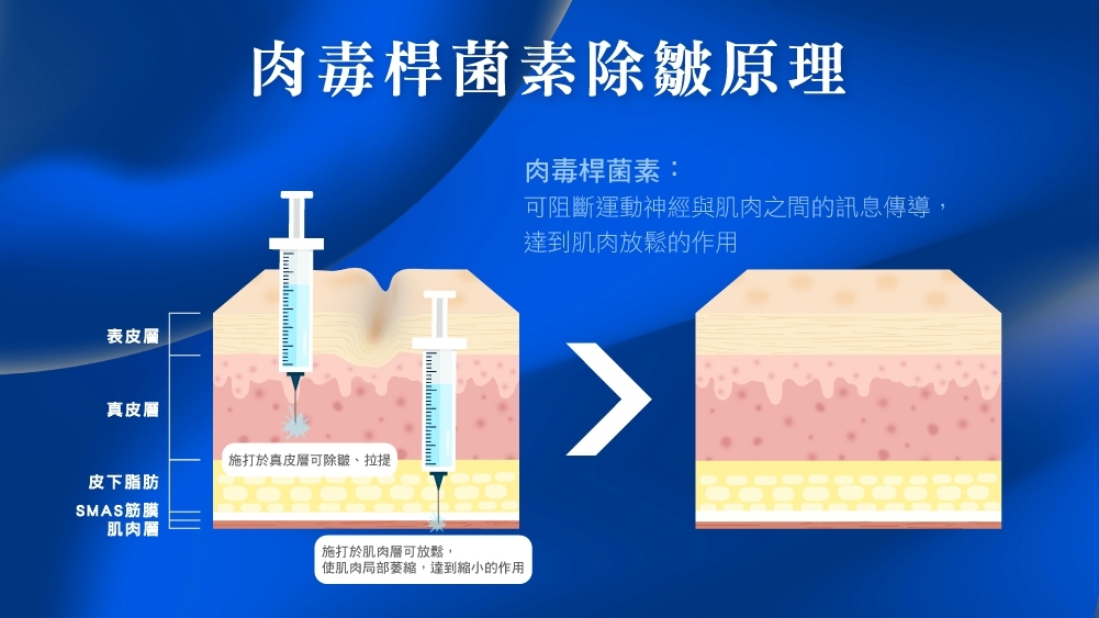 肉毒品牌 晶鑽診所 肉毒推薦 肉毒比較