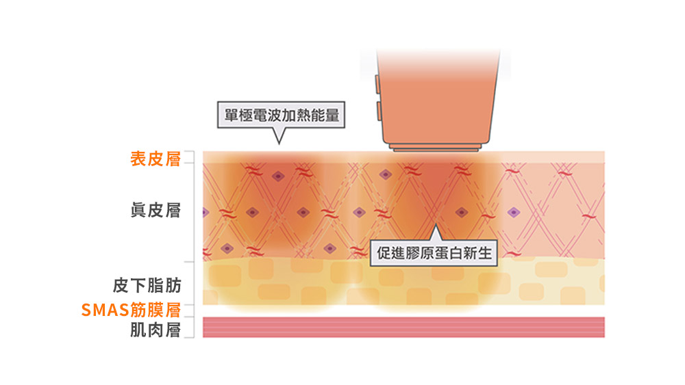 晶鑽診所 Oligio玩美電波 緊緻拉提 電波拉提 小鳳凰電波