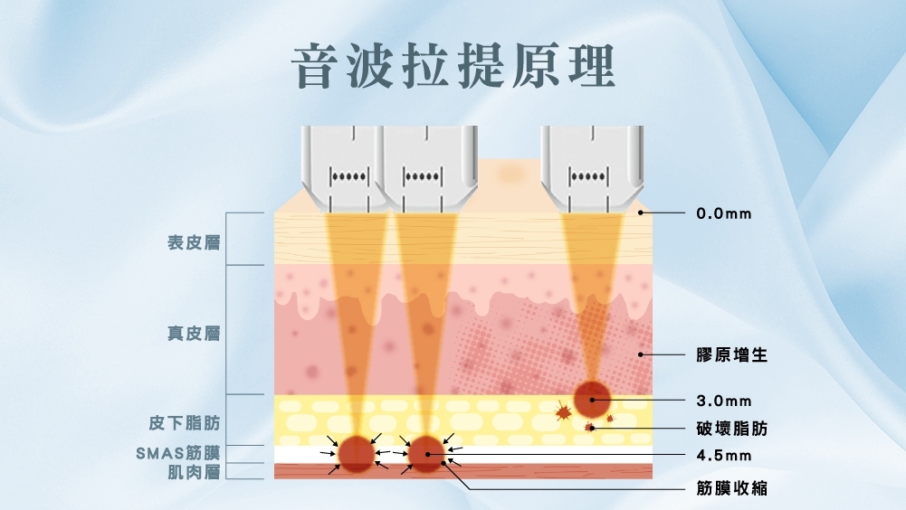 晶鑽診所 拉提效果 醫美推薦 電波音波的差異