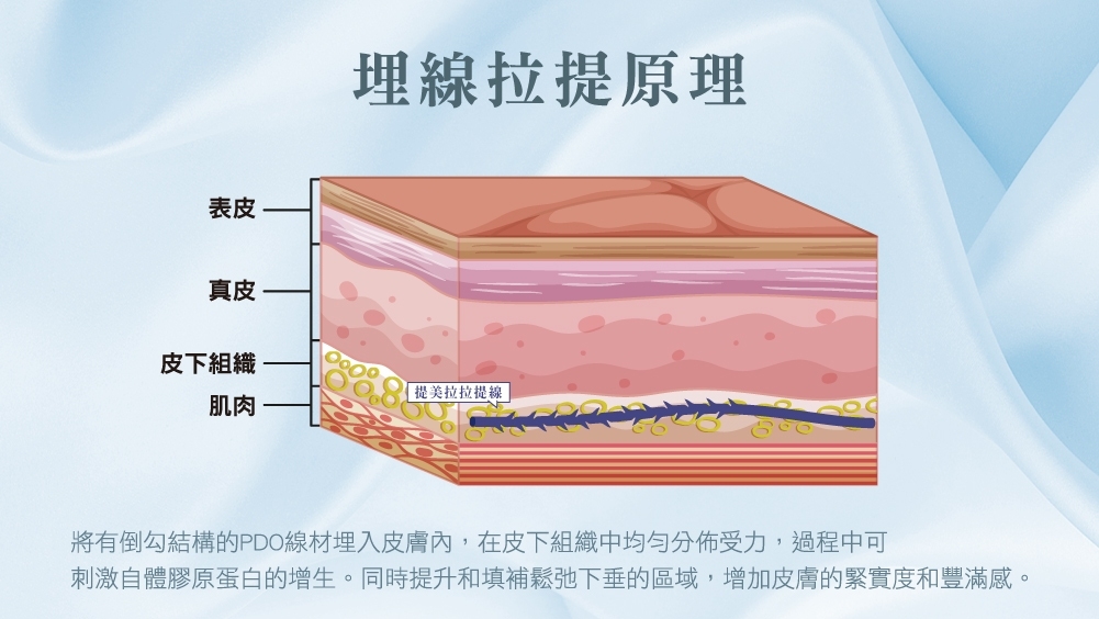 晶鑽診所 拉提醫美 音波 電波 埋線 醫美推薦