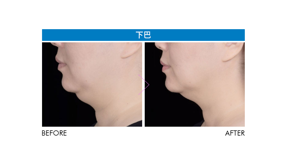 晶鑽診所 酷塑冷凍減脂術前術後比較