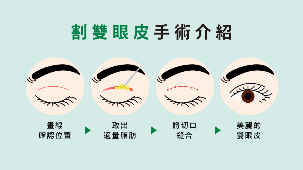 晶鑽診所 雙眼皮手術有哪些