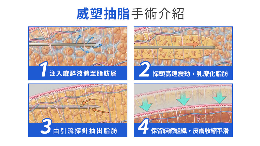 晶鑽診所 威塑抽脂的介紹