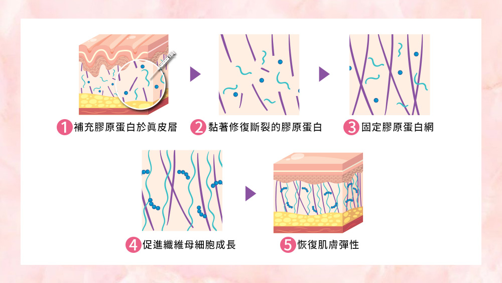 晶鑽診所_Sunmax双美膠原蛋白修補原理