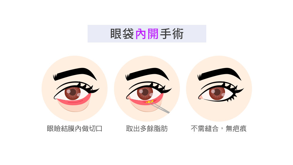 晶鑽診所_眼袋外開手術的步驟