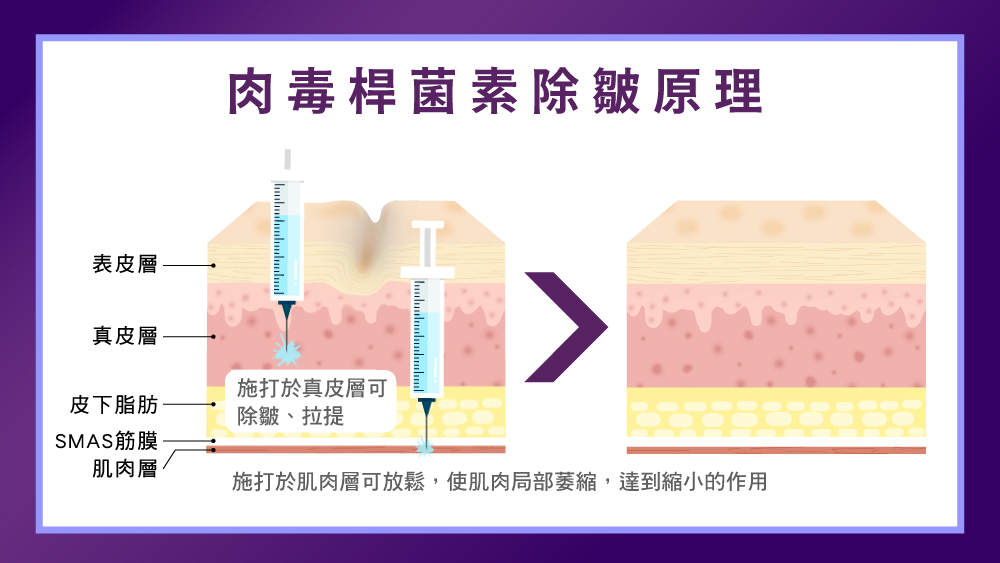 晶鑽診所-保妥適美國肉毒除皺原理