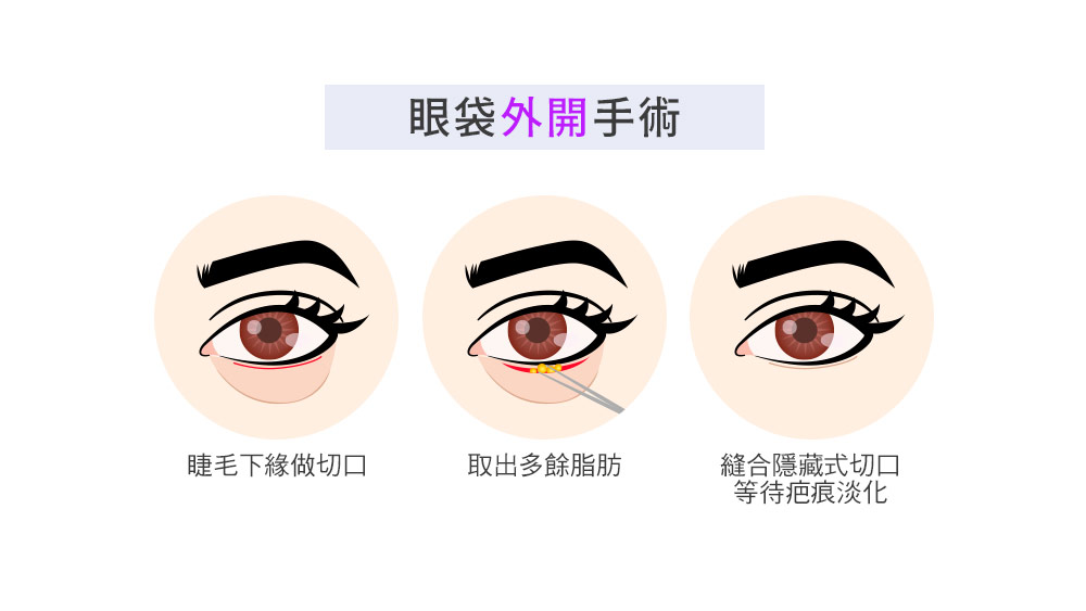 晶鑽診所_眼袋外開手術的步驟