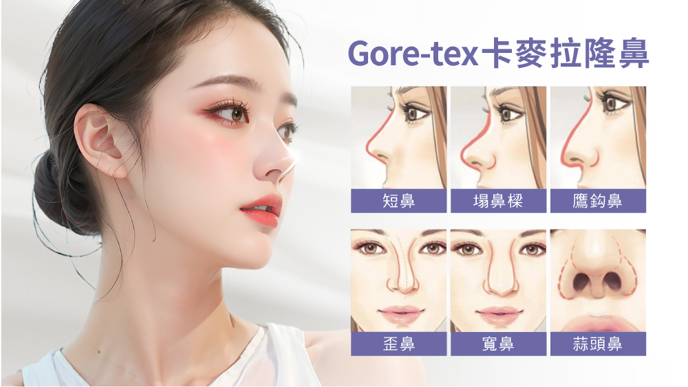 晶鑽診所-Gore-Tex卡麥拉隆鼻推薦