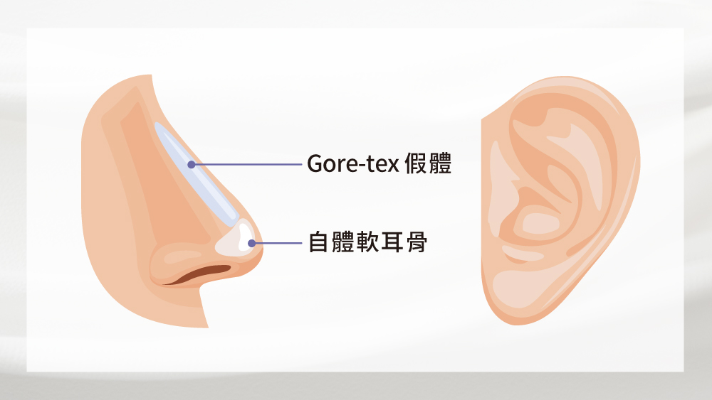 晶鑽診所-Gore-Tex卡麥拉隆鼻 二段式隆鼻