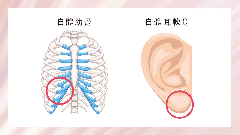 晶鑽診所_自肋與耳軟骨隆鼻介紹