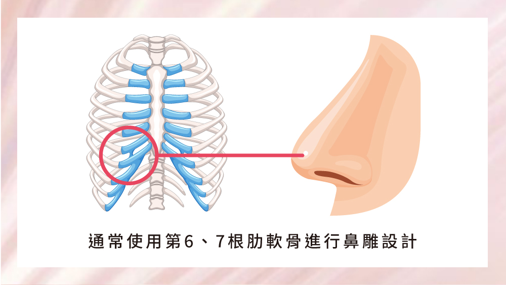 晶鑽診所_自肋隆鼻手術是什麼?