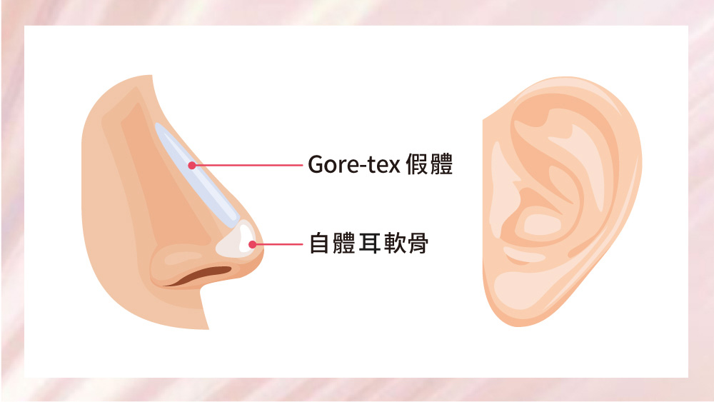 晶鑽診所_耳軟骨隆鼻推薦