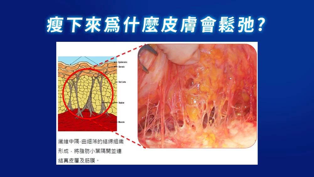 晶鑽診所 超能電漿是什麼? 超能電漿 介紹2皮膚鬆弛主因